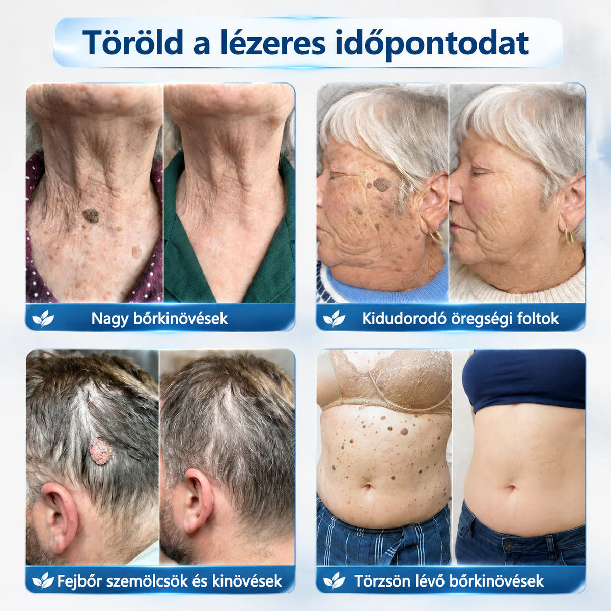 🥇Hivatalos áruház🎉CleraNaure® 7 napos pigmentfolt- és bőrhiba-eltüntető kezelés (Fájdalommentes, hegmentes görgős applikátor)