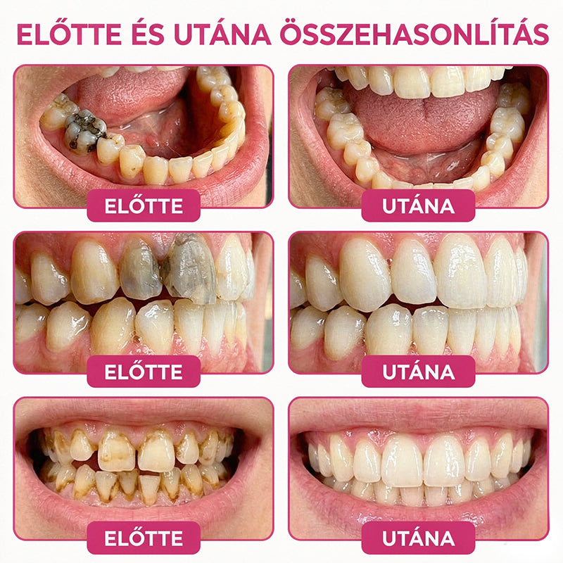 CleraNaure® DenPerm Üregjavító Természetes Zománctömő Gél