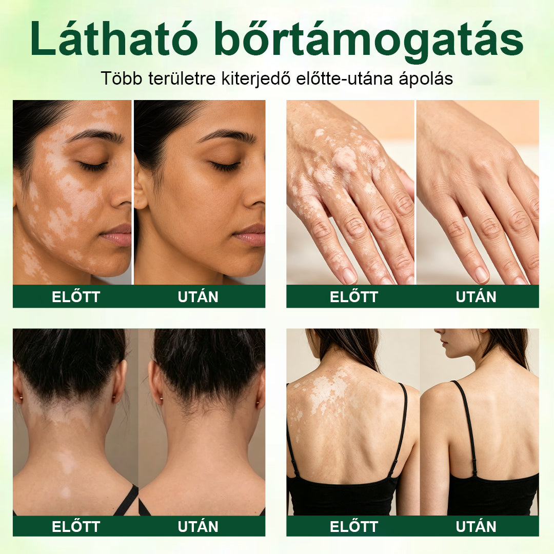 CleraNaure® Növényi Vitiligo Krém