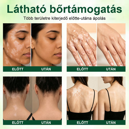 CleraNaure® Növényi Vitiligo Krém