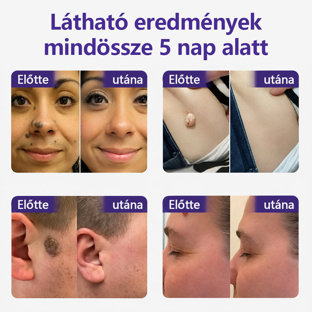👩🏻‍⚕️COLTURE® szemölcs- és anyajegytávolító mikrotűs tapasz-🌿
