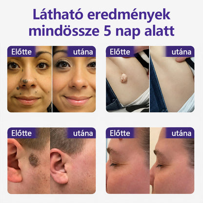👩🏻‍⚕️COLTURE® szemölcs- és anyajegytávolító mikrotűs tapasz-🌿
