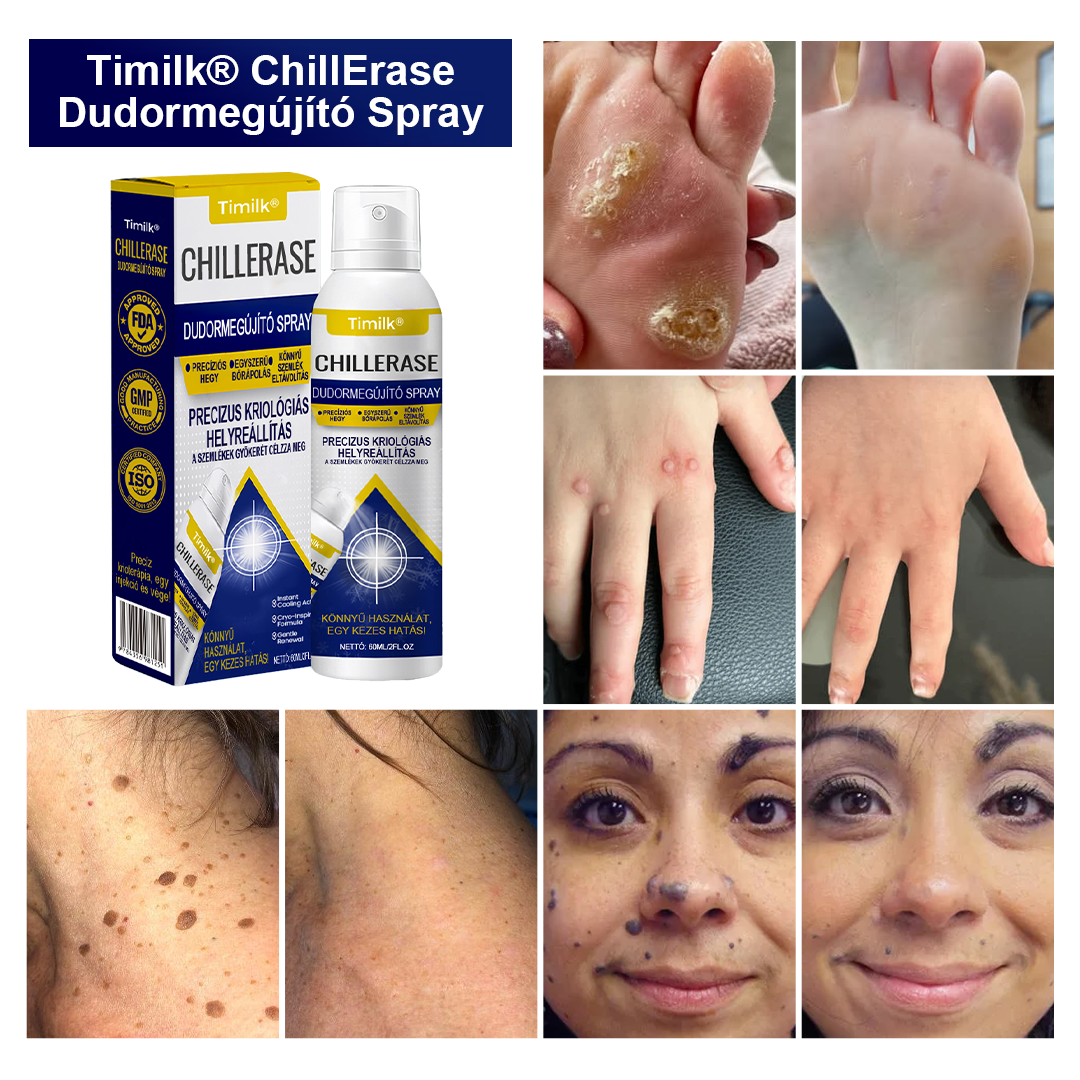 Timilk® ChillErase pattanásmegújító spray