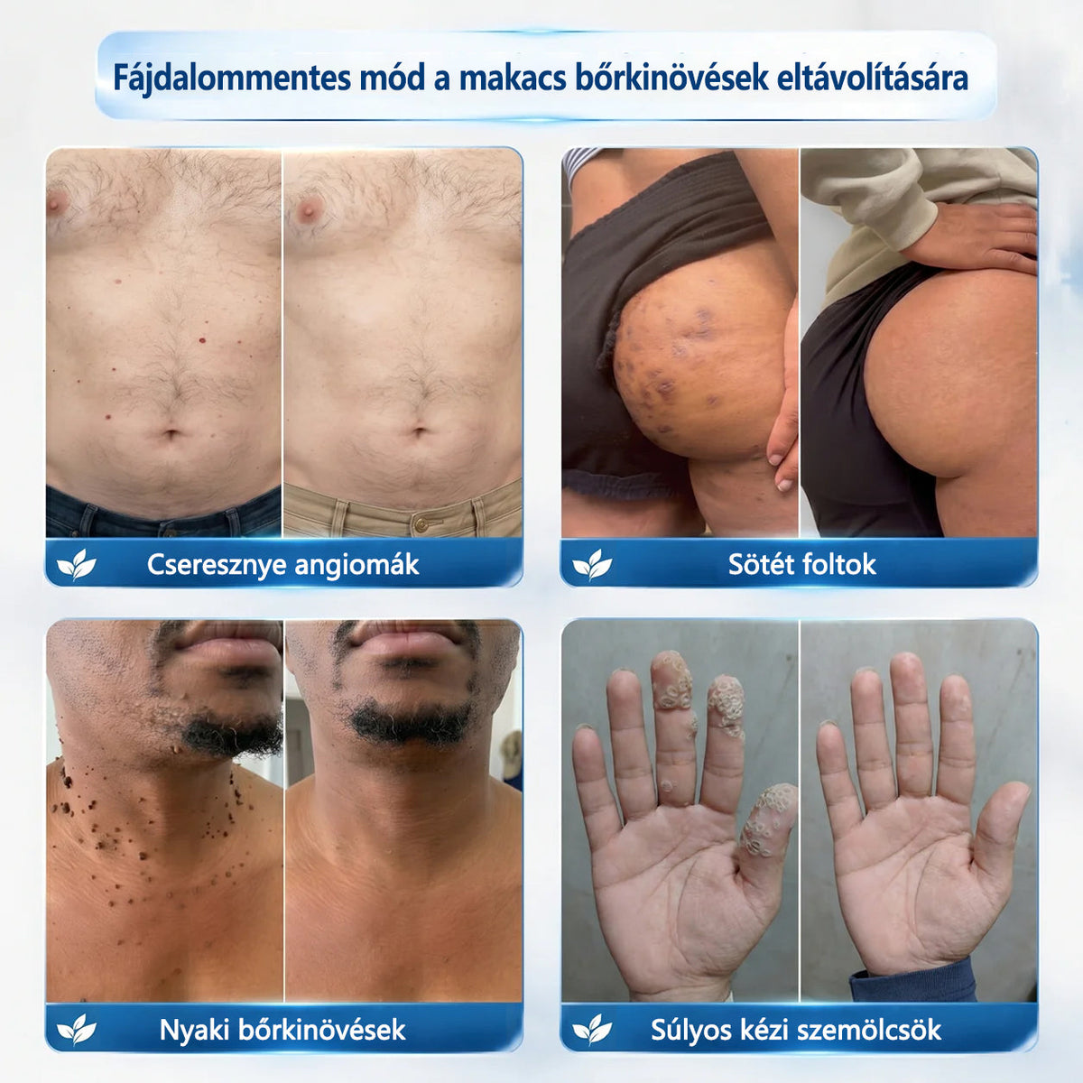 🥇Hivatalos áruház🎉CleraNaure® 7 napos pigmentfolt- és bőrhiba-eltüntető kezelés (Fájdalommentes, hegmentes görgős applikátor)