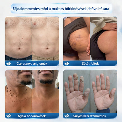 🥇Hivatalos áruház🎉CleraNaure® 7 napos pigmentfolt- és bőrhiba-eltüntető kezelés (Fájdalommentes, hegmentes görgős applikátor)