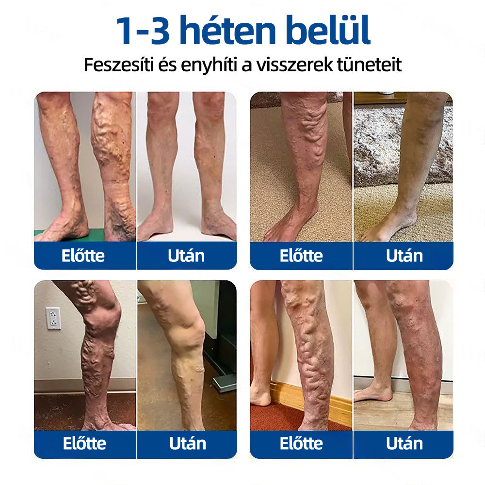 🇭🇺𝐇𝐞𝐚𝐥𝐫𝐢𝐳𝐞® 👩‍⚕️VeinTarget mikrotűs tapasz⚡☑️Azonnali enyhülés hosszú távú eredmények-🔥