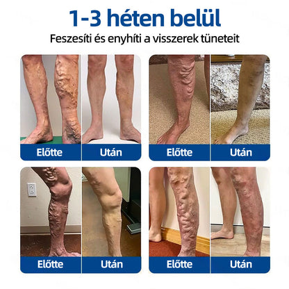 🇭🇺𝐇𝐞𝐚𝐥𝐫𝐢𝐳𝐞® 👩‍⚕️VeinTarget mikrotűs tapasz⚡☑️Azonnali enyhülés hosszú távú eredmények-🔥