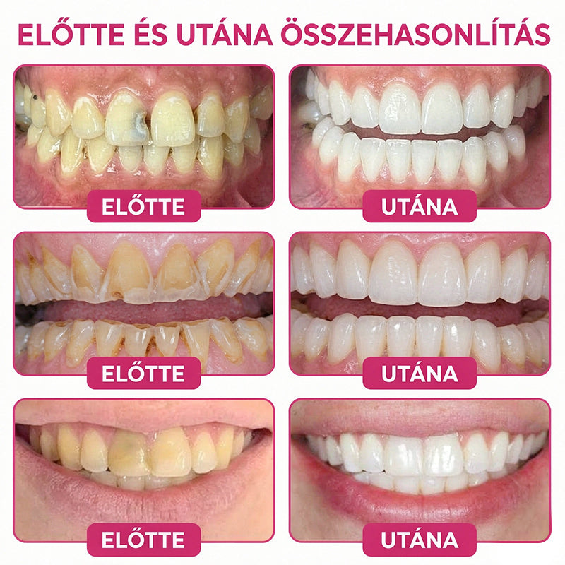 CleraNaure® DenPerm Üregjavító Természetes Zománctömő Gél