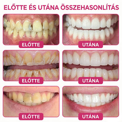 CleraNaure® DenPerm Üregjavító Természetes Zománctömő Gél