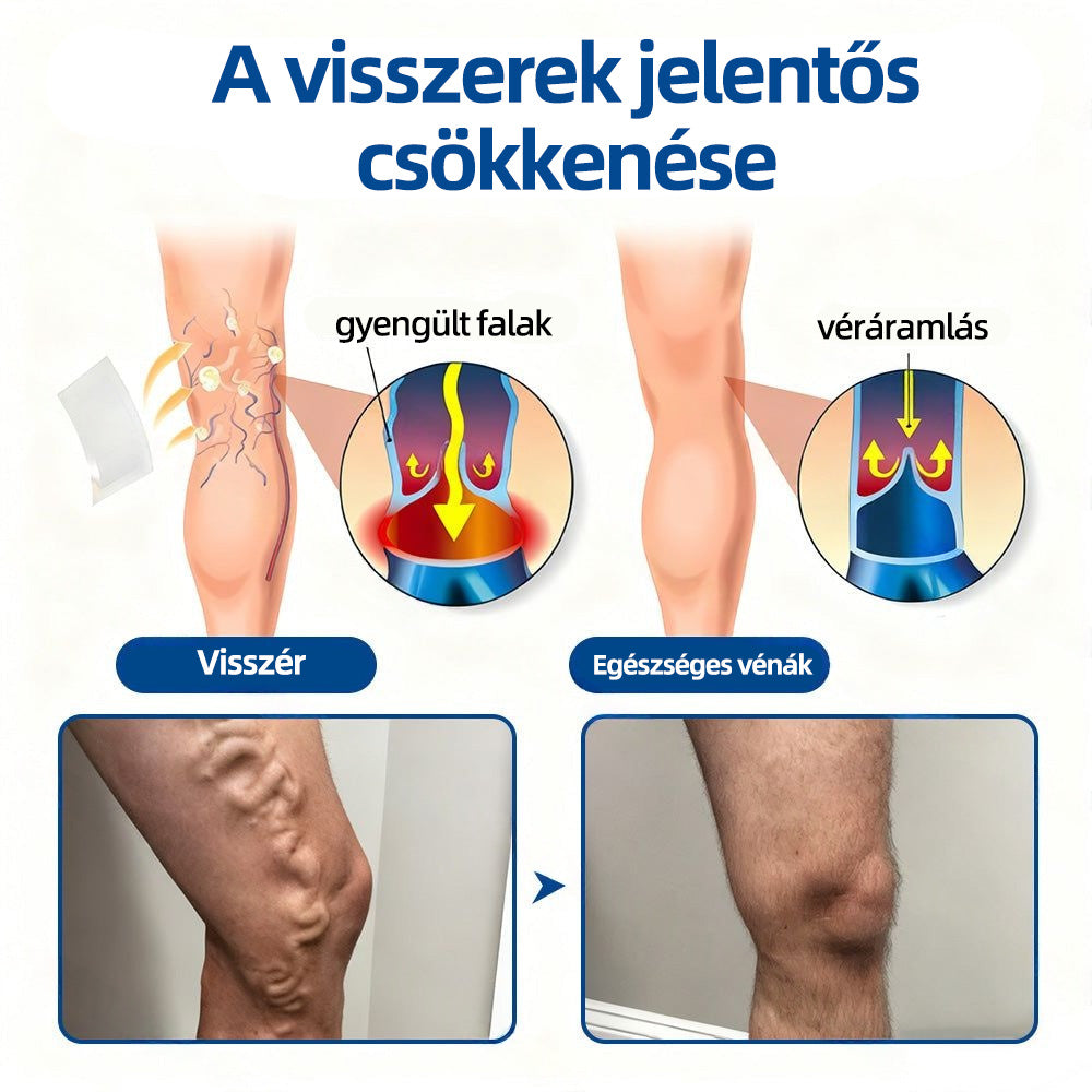 🇭🇺𝐇𝐞𝐚𝐥𝐫𝐢𝐳𝐞® 👩‍⚕️VeinTarget mikrotűs tapasz⚡☑️Azonnali enyhülés hosszú távú eredmények-🔥