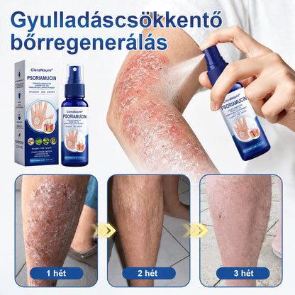 🥇CleraNaure® PsoriaMucin Dörzsölésmentes Viszketés- és Pikkelyenyhítő Permet