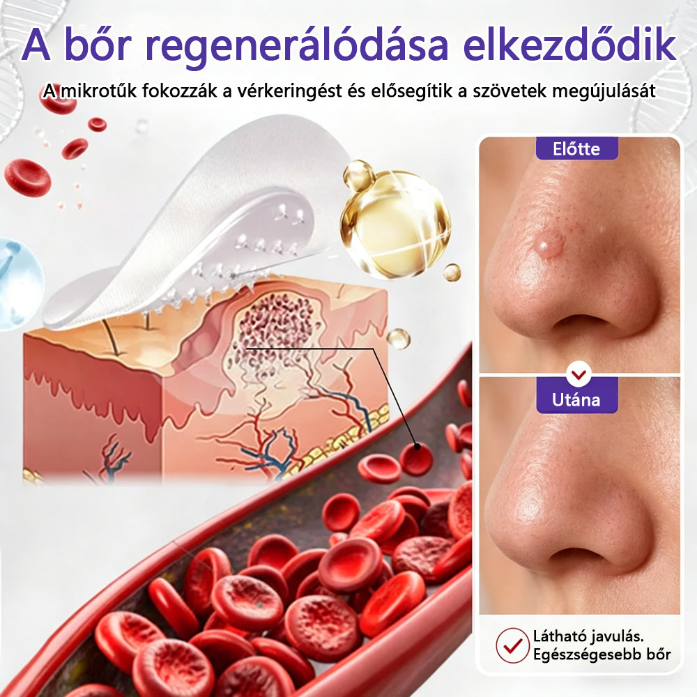 👩🏻‍⚕️COLTURE® szemölcs- és anyajegytávolító mikrotűs tapasz-🌿