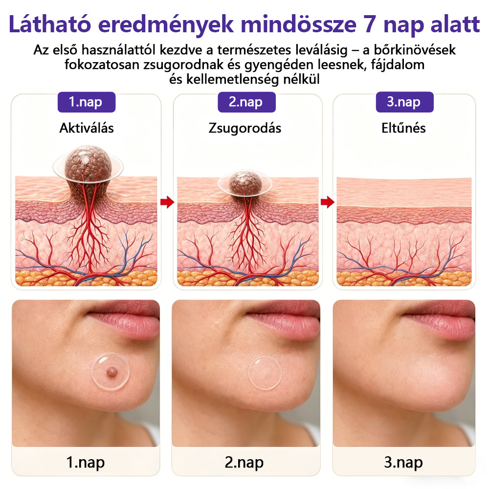 👩🏻‍⚕️COLTURE® szemölcs- és anyajegytávolító mikrotűs tapasz-🌿
