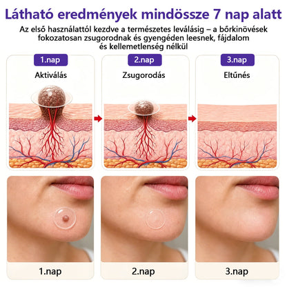 👩🏻‍⚕️COLTURE® szemölcs- és anyajegytávolító mikrotűs tapasz-🌿