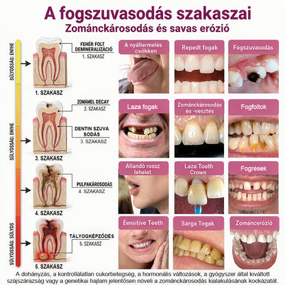CleraNaure® DenPerm Üregjavító Természetes Zománctömő Gél