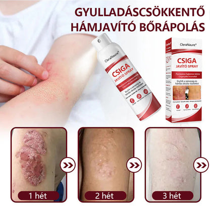 ✨CleraNature® Bálnazsír Spray Viszkető, Hámló Psoriasisra Hajlamos Bőrre