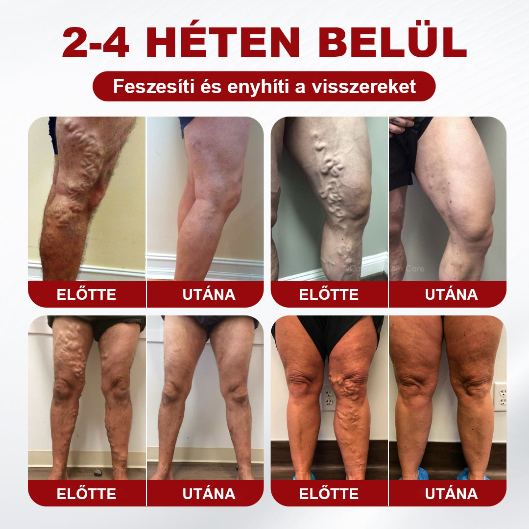 🥇CleraNaure® visszérkezelő krém