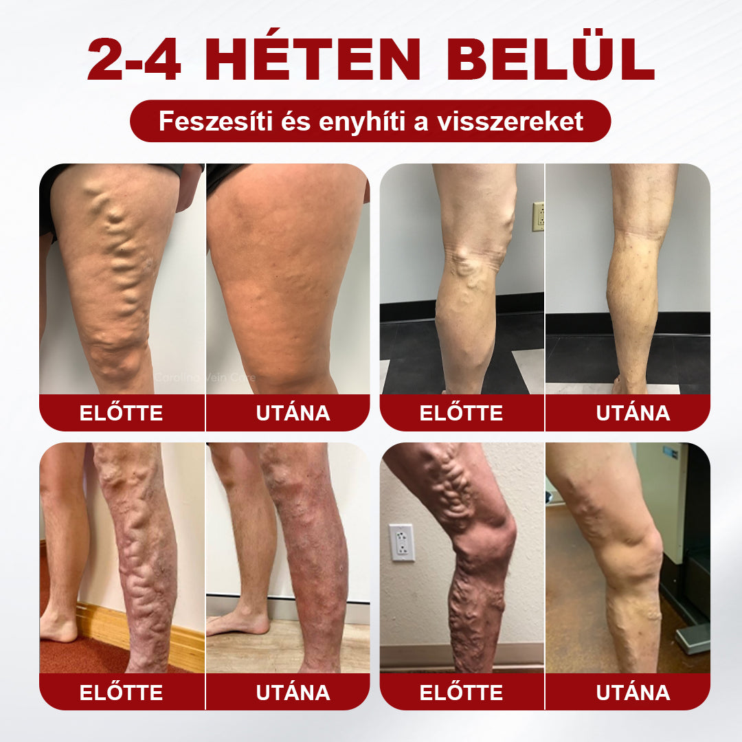 🥇CleraNaure® visszérkezelő krém